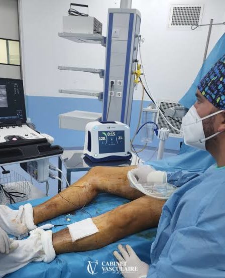 Laser varices