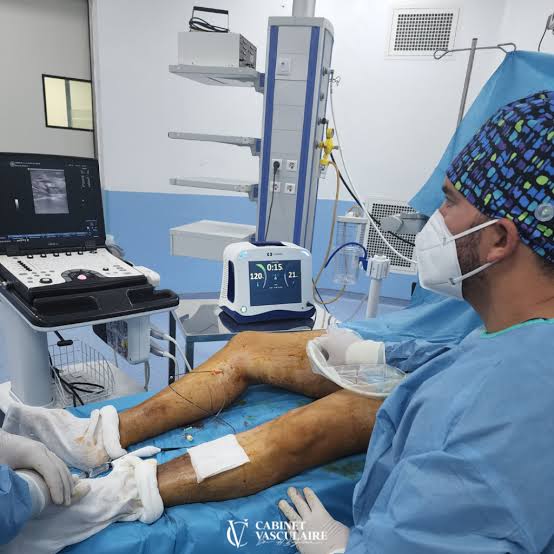 Laser varices